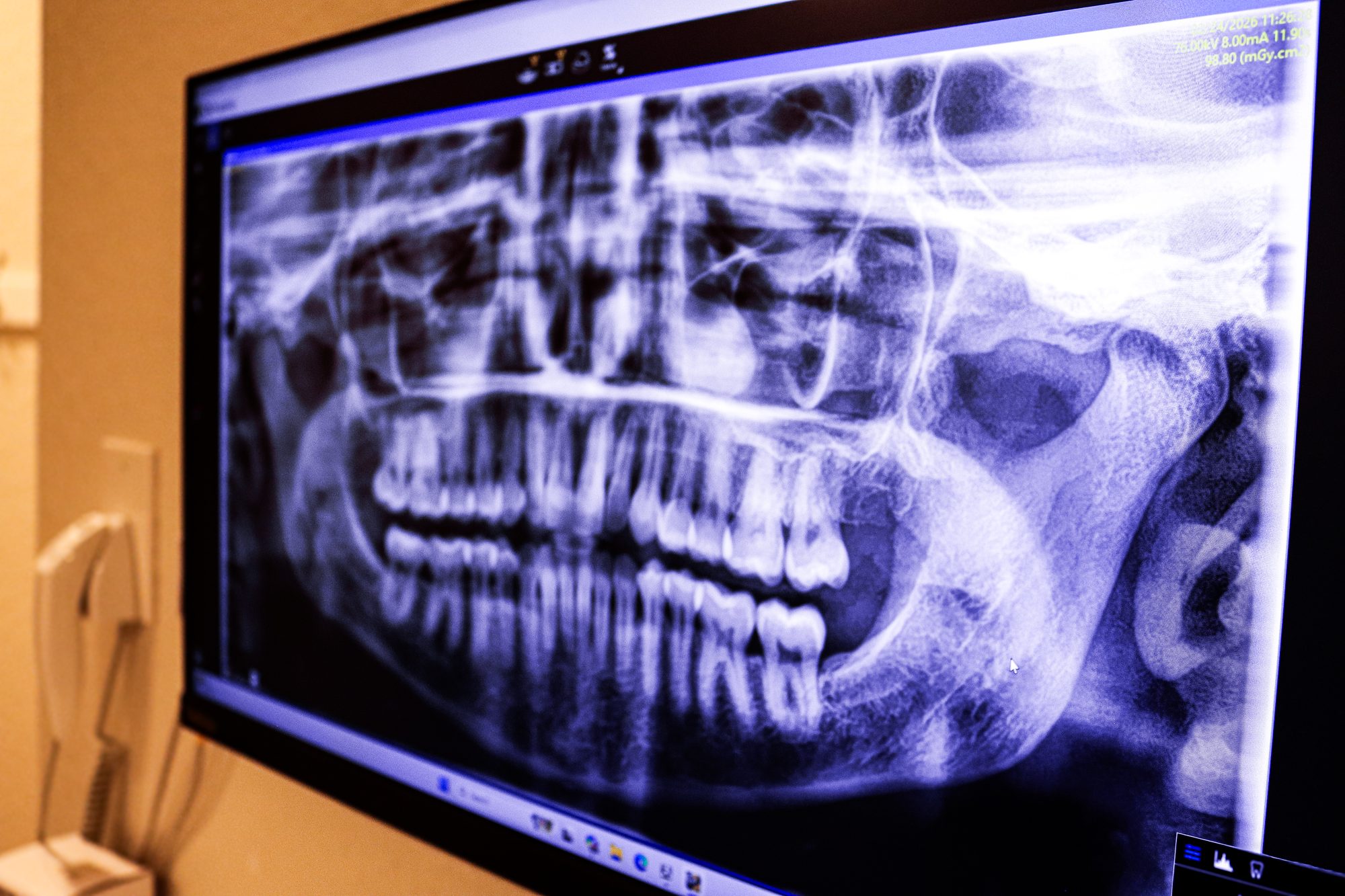 Low-radiation panoramic X-ray on a chairside monitor
